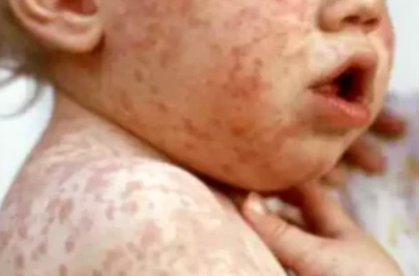  GIFT FROM ILLEGAL IMMIGRANTS – Measles Spike Is So Extreme It Threatens Elimination in the US